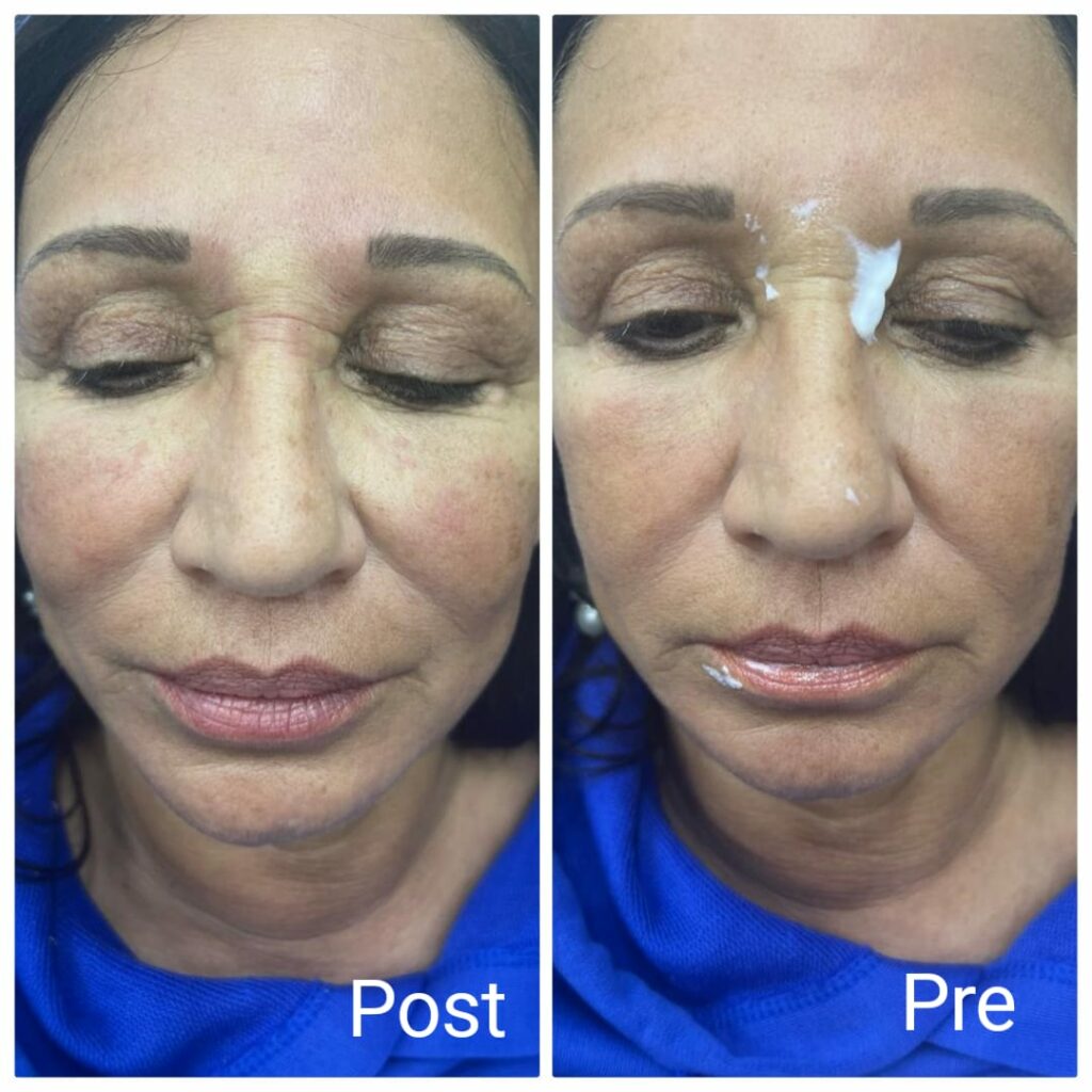 فيلر الخدود قبل وبعد